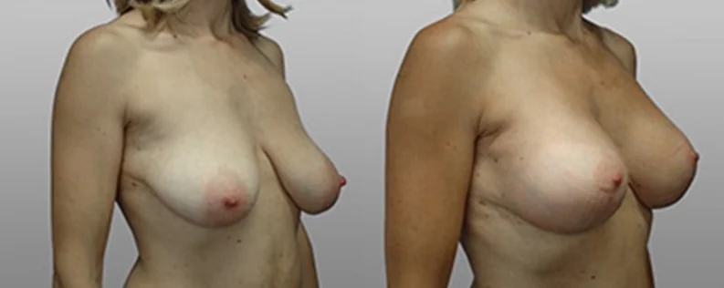 Breast Lift with Implants | 4