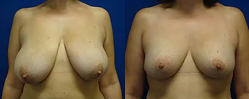 Breast Reduction Surgery (Reduction Mammaplasty) | 2