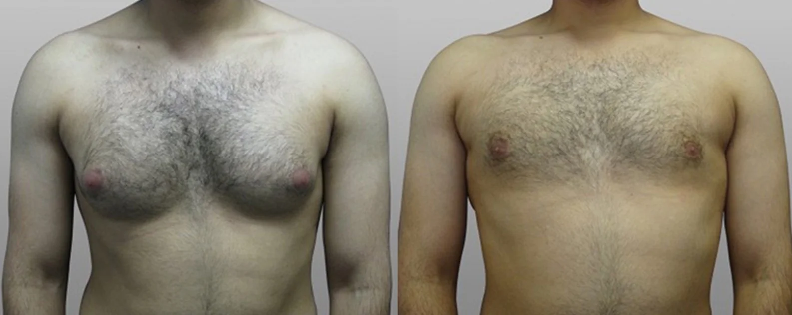 Surgery for Gynaecomastia | 1
