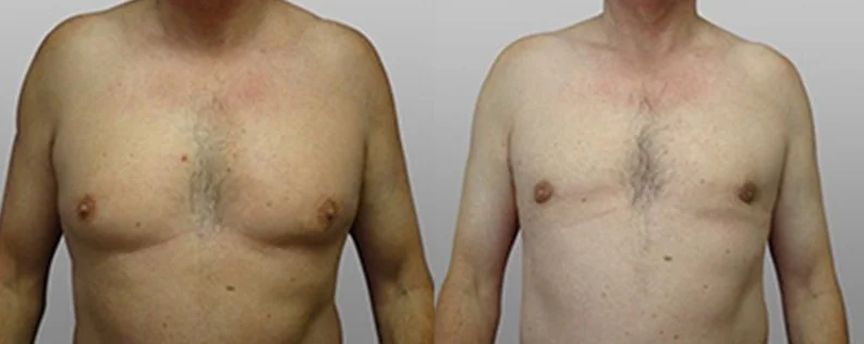 Surgery for Gynaecomastia | 2