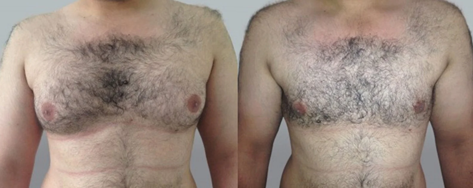 Surgery for Gynaecomastia | 3