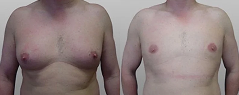 Surgery for Gynaecomastia | 4