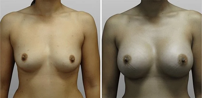 Breast Reconstruction Surgery | 1