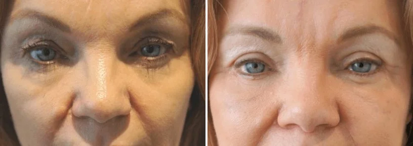 Facial fat transfer & eyelid surgery 06, upper and lower blepharoplasty