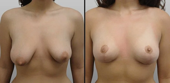 Tuberous Breasts | 2